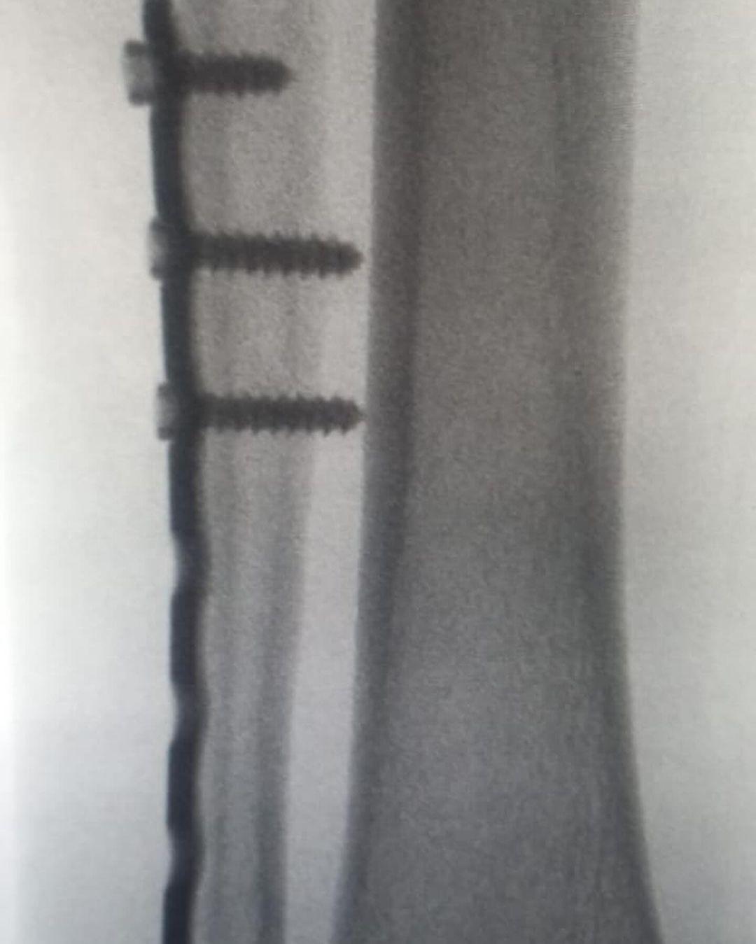 Se+me+han+perdido+los+pasosPor+las+sendas+de+la+vida+De+a+poquito+iré+volviendo,+un+tropezón+no+es+caída++Feliz+2024+familia+amada.++Yo+inicié+el+2024+con+pata+nuevecita!+un+poco+remachada+sí,pero+nuevecita+al+fi (1)